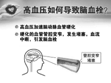 老年人 过度降压风险大