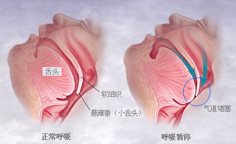 打呼噜到底有多糟？